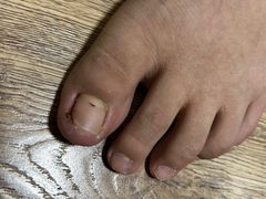 -祖传修脚甲沟炎灰指甲鸡眼