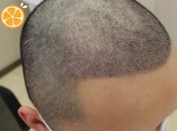 -大麦微针植发丨全国连锁