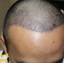 -大麦微针植发丨全国连锁