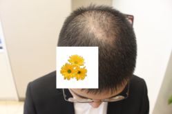 -大麦微针植发丨全国连锁