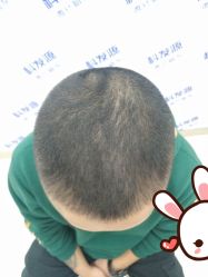 -大麦微针植发丨全国连锁