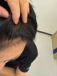 -大麦微针植发全国连锁
