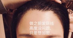 点击看大图 体验前-大麦微针植发全国连锁