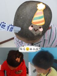 点击看大图 -碧莲盛·不剃发植发