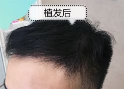 -大麦微针植发全国连锁