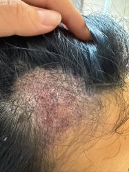 -碧莲盛·不剃发植发