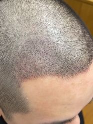 -大麦微针植发全国连锁