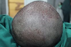 点击看大图 -大麦微针植发丨全国连锁