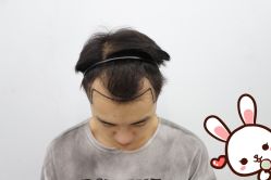 点击看大图 -大麦微针植发丨全国连锁