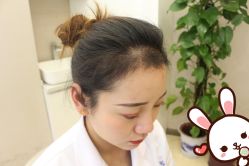 -大麦微针植发丨全国连锁