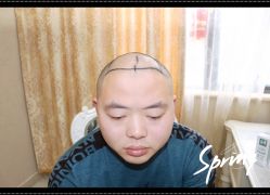 点击看大图 体验后-大麦微针植发全国连锁