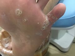 -世龙世家灰指甲·甲沟炎·跖疣护理·修脚(东江湾路店)