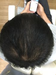 -菩叶脱发白发中心