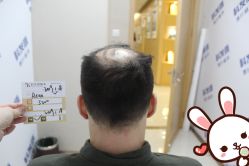 -大麦微针植发丨全国连锁