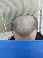 -大麦微针植发丨全国连锁