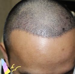 -大麦微针植发丨全国连锁