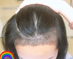 -大麦微针植发丨全国连锁