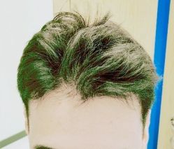 -大麦微针植发丨全国连锁