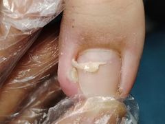 -祖传修脚甲沟炎灰指甲鸡眼