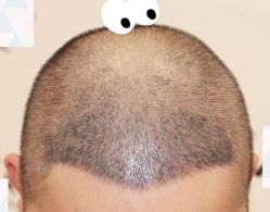 -大麦微针植发全国连锁