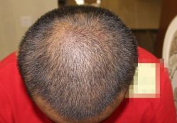 -大麦微针植发丨全国连锁