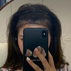 -碧莲盛·不剃发植发