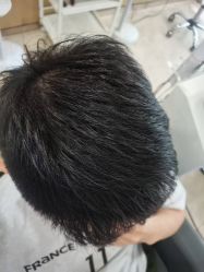 -大麦微针植发丨全国连锁