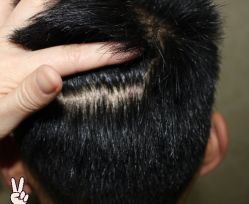 -大麦微针植发丨全国连锁