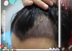 -大麦微针植发全国连锁