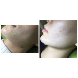 点击看大图 -苗方清颜痘肌研究所