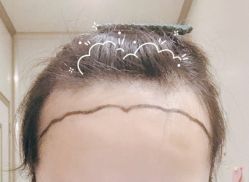 -大麦微针植发全国连锁