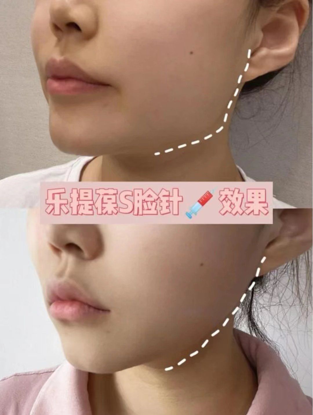 瘦脸针对比图效果展示,医美初体验
