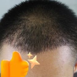 -大麦微针植发丨全国连锁