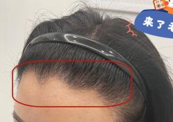 -大麦微针植发全国连锁