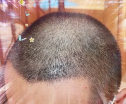 -大麦微针植发全国连锁