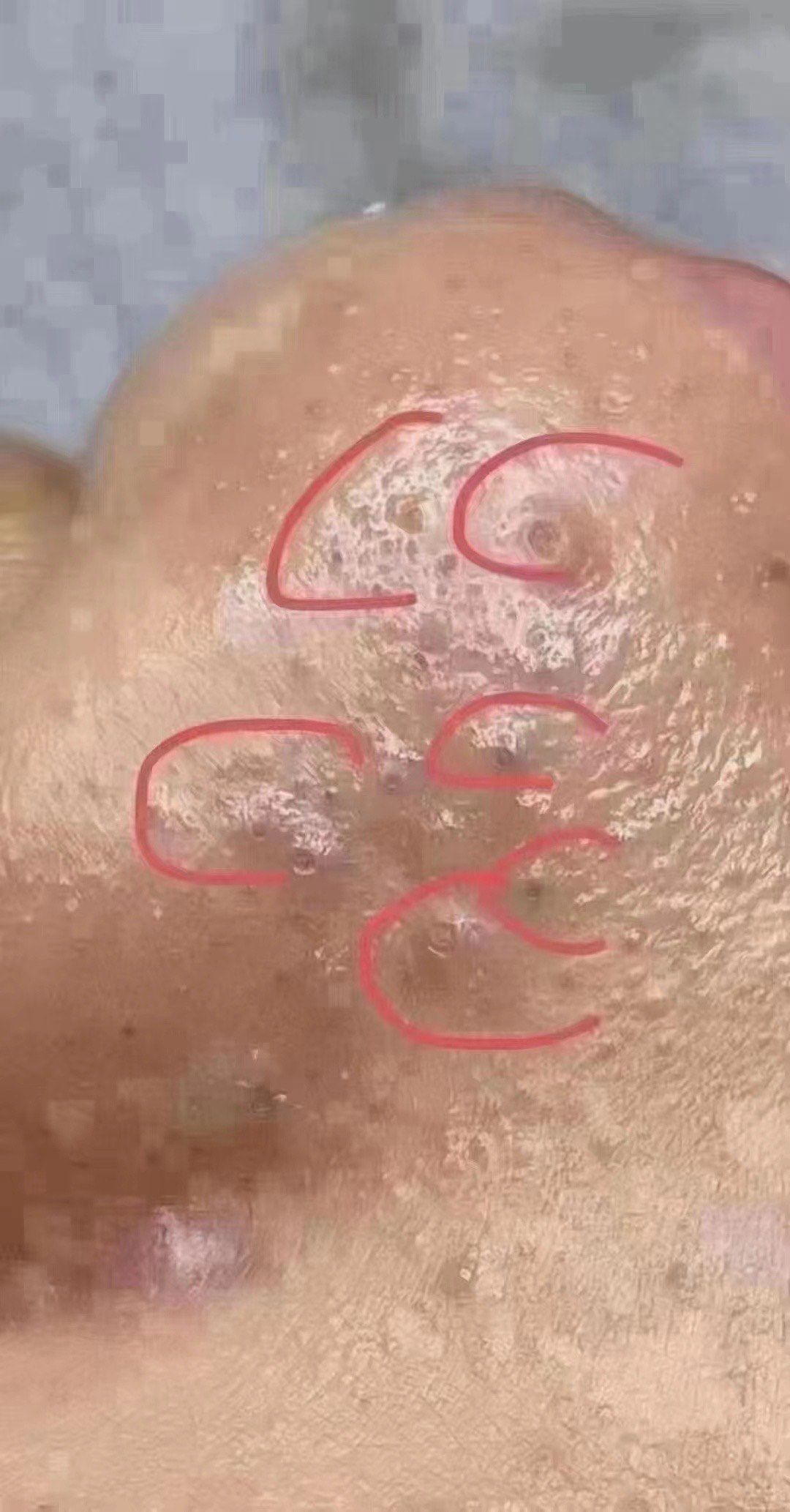 毛孔堵塞太可怕啦