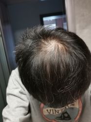 -碧莲盛·不剃发植发