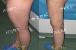 大腿吸脂01-西美医疗美容门诊部
