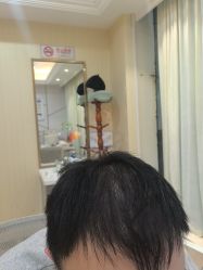 -碧莲盛·不剃发植发