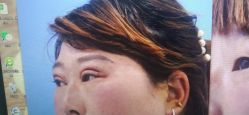 体验后-西安壹加壹医疗美容·西北抗衰旗舰店