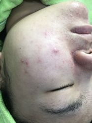 -苗医生草本科技祛痘