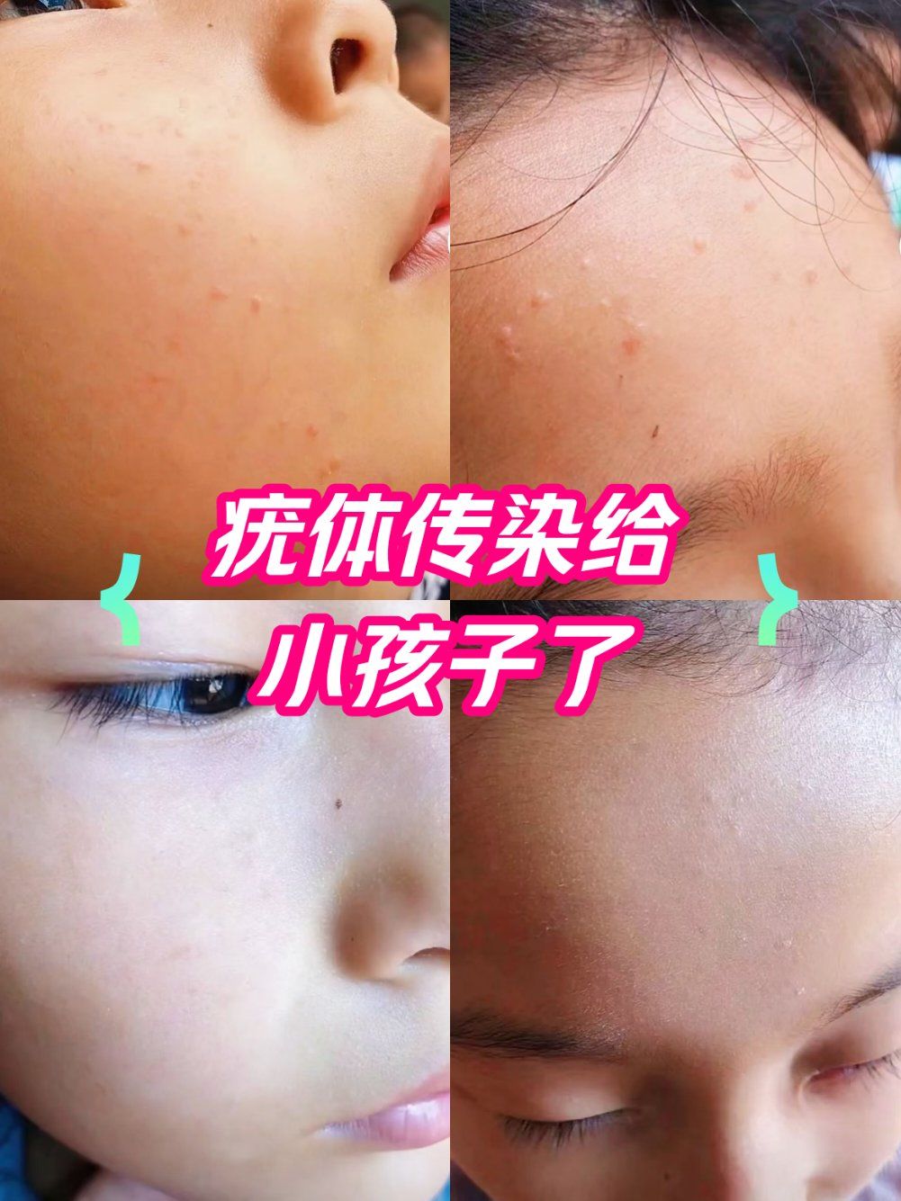 疣是发现一个做一个 ,绝对不能等!