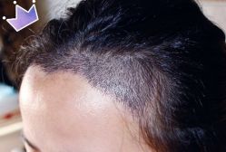 -大麦微针植发丨全国连锁