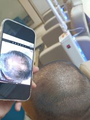 -碧莲盛·不剃发植发