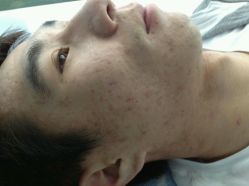 android_upload_pic-韩医生专业祛痘连锁机构