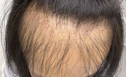 体验后-熙朵美学植发·连锁品牌