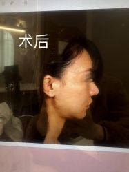 体验后-杭州米兰柏羽医疗美容医院
