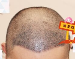 -大麦微针植发全国连锁