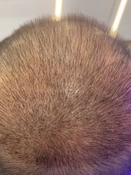 -大麦微针植发全国连锁