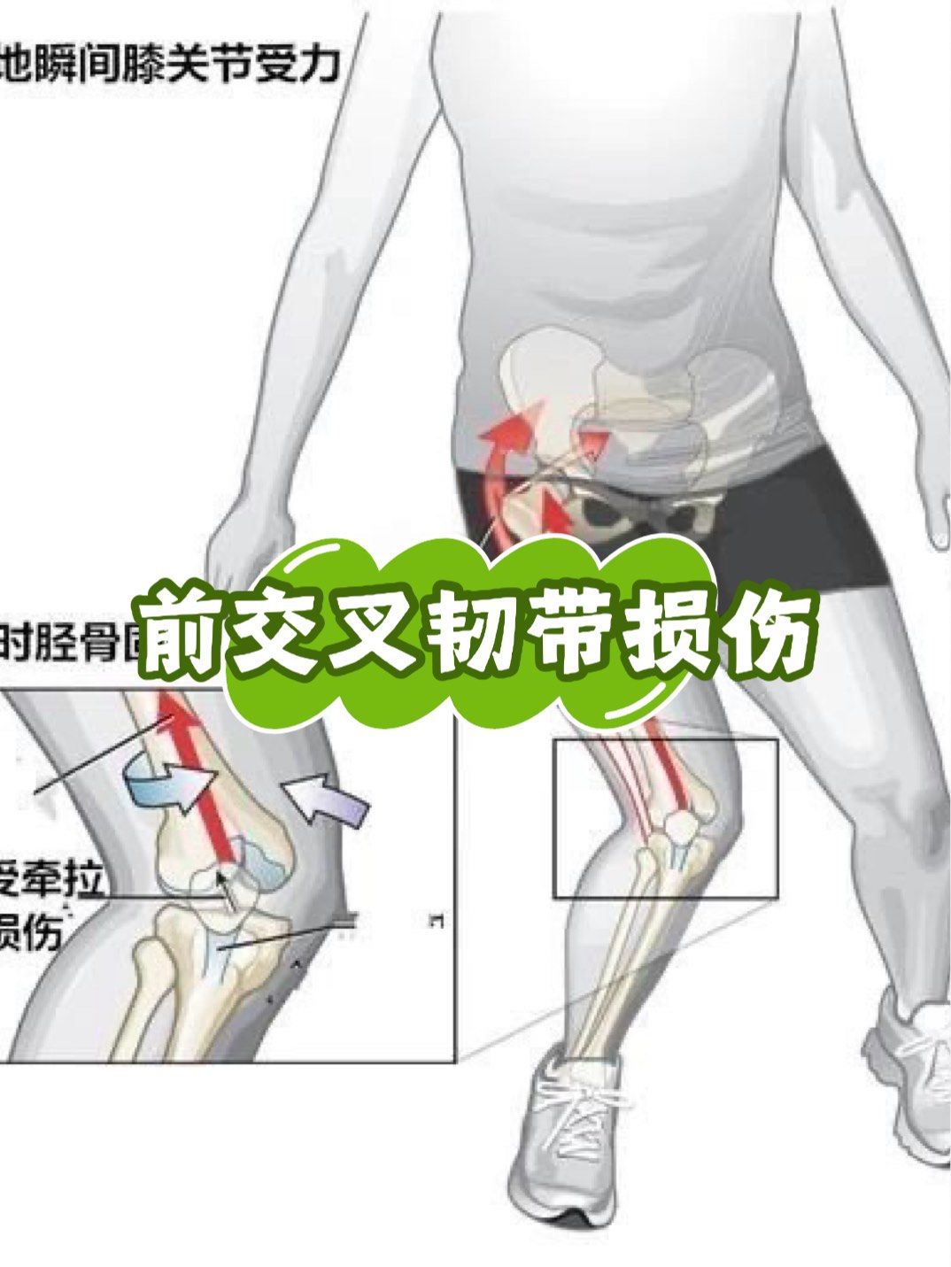 前交叉韧带